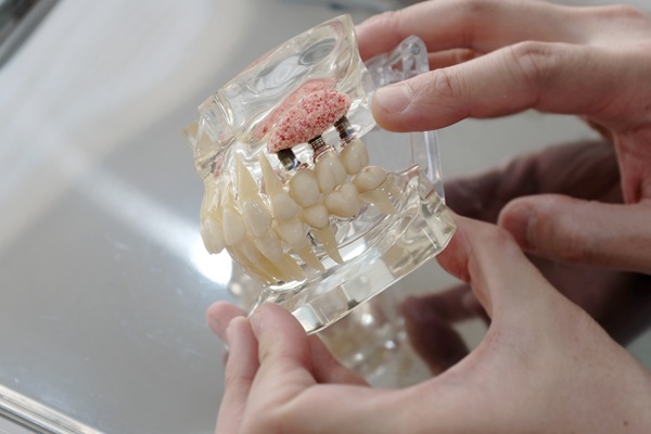 How Bone Grafts Protect Jaw Health And Expand Tooth Replacement Options