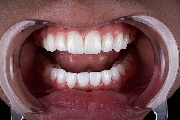 Dental Bonding From A General Dentist