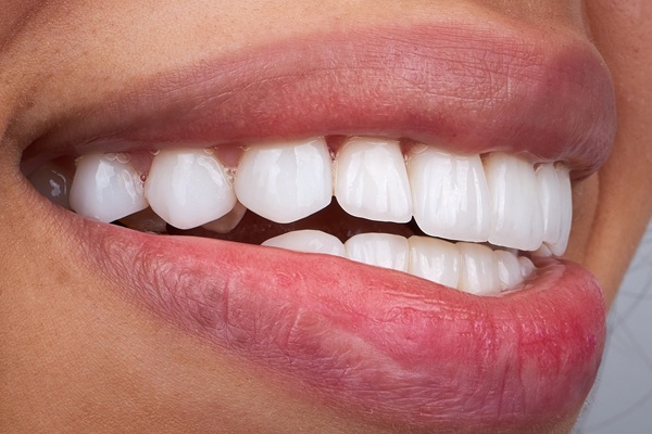 What’s The Difference Between Dental Bonding And Veneers?