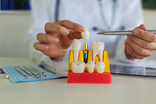 What To Know About The Dental Crown Process
