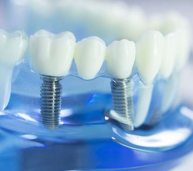 San Antonio Dental Implants